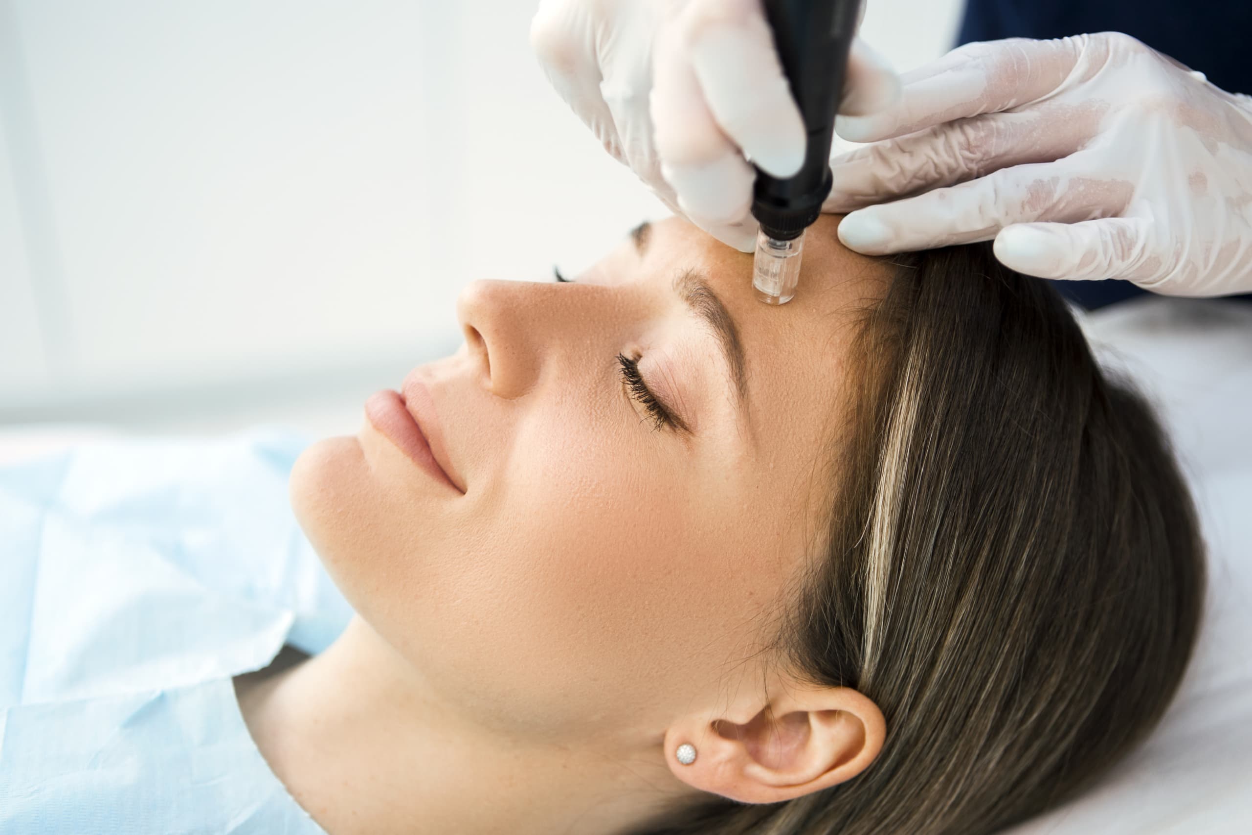 Microneedling