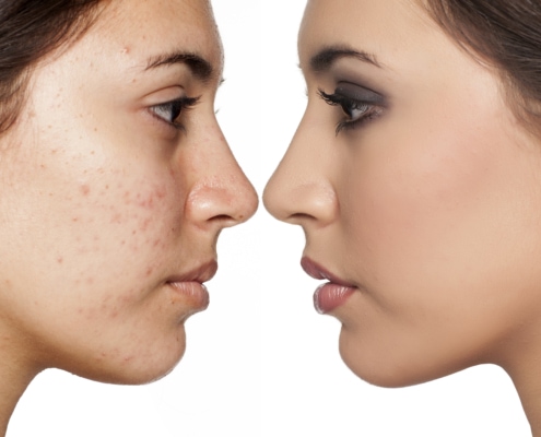 Rosacea behandling