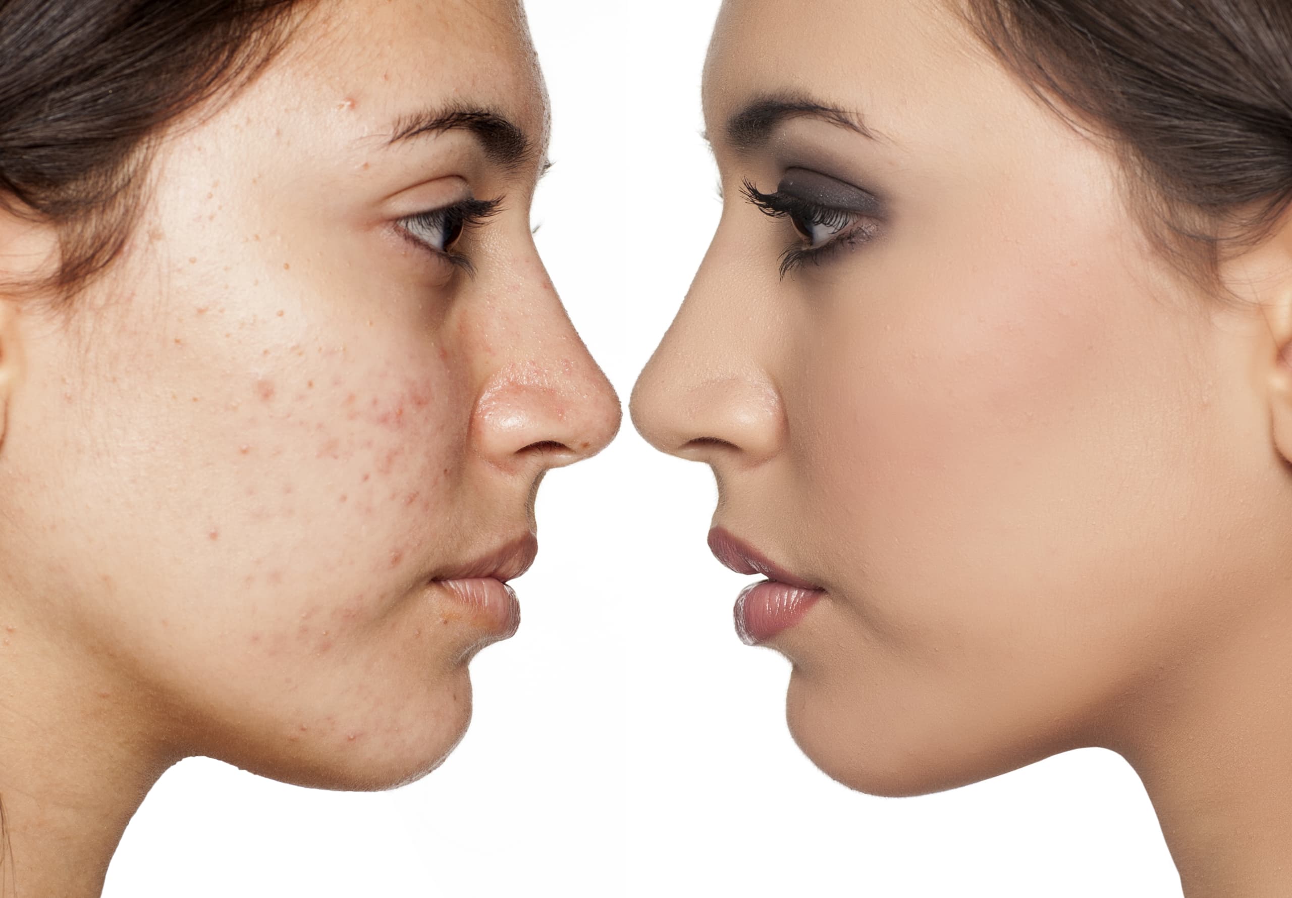 Rosacea behandling