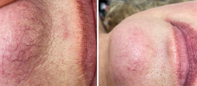 Kärlbehandling - IPL-laser mot rosacea