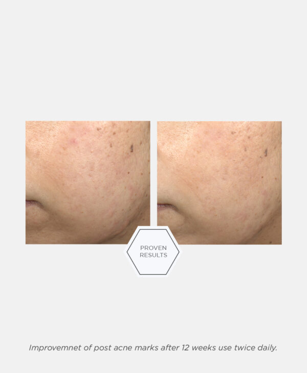 Post-Acne Mark Correcting Serum - Bild 6